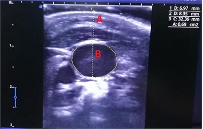 The Right Internal Jugular at the Cricoid Cartilage Level May Represent the Optimal Central Vein Puncture Site in Pediatric Patients
